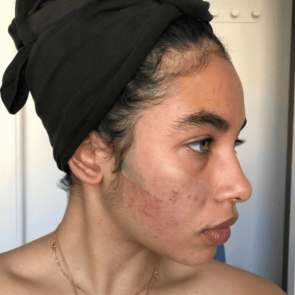 Kvinna med transparent silikontejp applicerad över kinden för hudvård och behandling av akneärr.